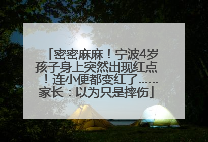 密密麻麻！宁波4岁孩子身上突然出现红点！连小便都变红了……家长：以为只是摔伤